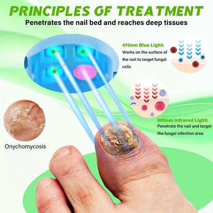 Nail Fungus Laser Treatment Device, FDA Cleared Anti-Fungal Laser for Toenail & Fingernail Fungal Infections