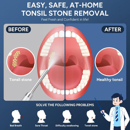 Visual Tonsil Stone Remover with 1080P HD Camera – 6 LED Lights, 5 Stainless Steel Heads, Bad Breath Prevention, iOS & Android Compatible