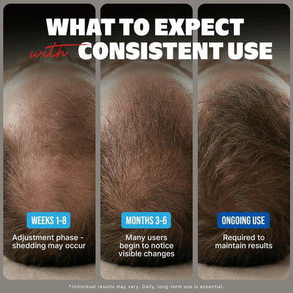 Minoxidil 5% Extra Strength Topical Solution for Men Hair Regrowth - Kirkland Signature 6-Month Supply