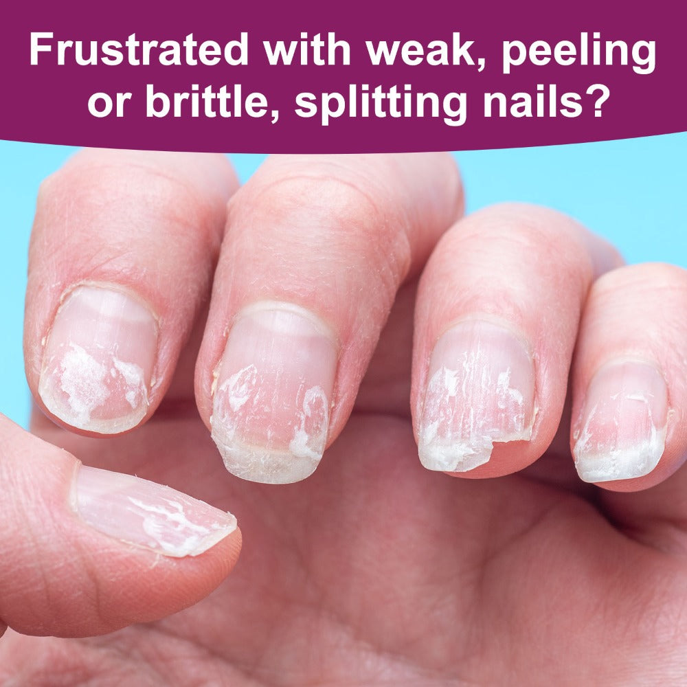 Nail Fortifier & Hardener 10ml Protective Strengthening Agent for Weak Damaged Brittle Nails – Makes Nails Stronger Tougher & Resilient