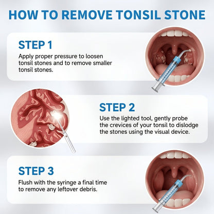 Tonsil Stone Remover with Camera - 1080P HD Visual Tonsil Stone Removal Tool with LED Light, 5-in-1 Stainless Steel Tips