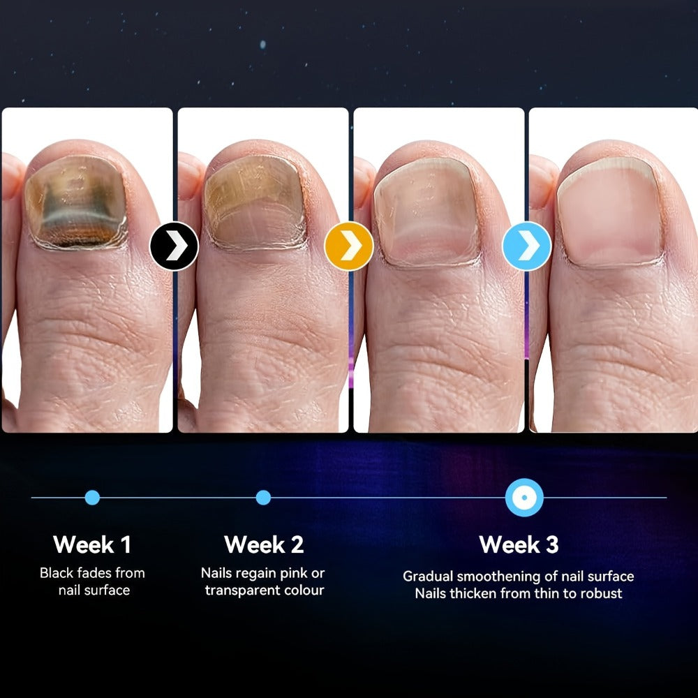 Nail Fungus Treatment Device, FDA Cleared Light Therapy for Toenails & Fingernails for Home and Salon Manicures