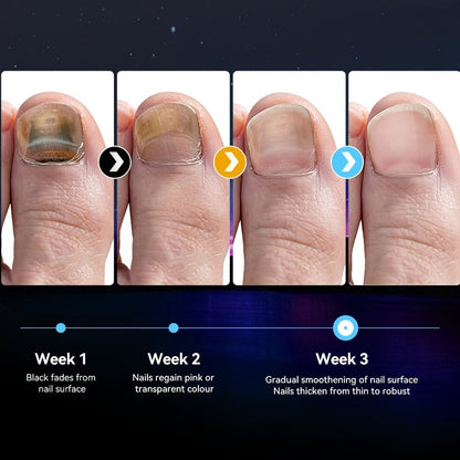 Nail Fungus Treatment Device, FDA Cleared Light Therapy for Toenails & Fingernails for Home and Salon Manicures