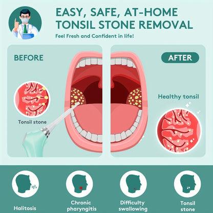 Tonsil Stone Remover Electric Vacuum Kit with LED Light – 3 Suction Modes 5X Magnifying Mirror Oral Irrigator Safe Gentle Tonsillolith