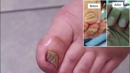 KTS Nail Fungus Laser Device FDA Cleared, Extra Strength 407nm Blue Light & 905nm Dual-Light Treatment for Toenail & Fingernail Fungus